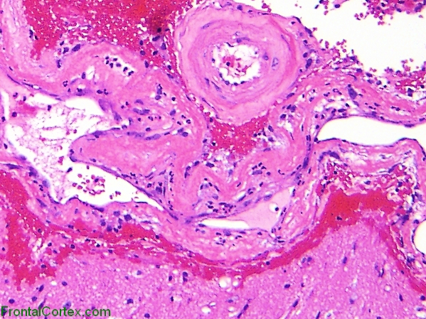 Amyloid Angiopathy, H&E stain slide